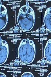 The Alzheimer's Project: Momentum in Science