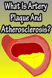 What Is Artery Plaque And Atherosclerosis?