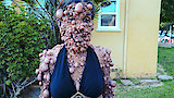 The Woman Covered in Thousands of Tumors